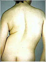 scoliosis-posture