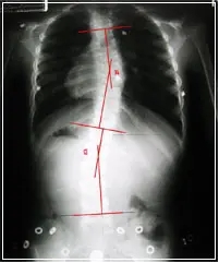 scoliosis-x-ray-after-2