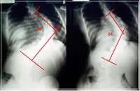 Scoliosis Before x-ray