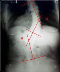 scoliosis-x-ray-before-2