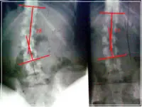 scoliosis-x-ray-after-1 Scoliosis After x-Ray
