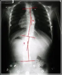 scoliosis-x-ray-after-2 scoliosis-x-ray-after-2