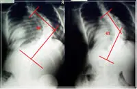 scoliosis-x-ray-before-1 Scoliosis Before x-ray