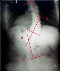 scoliosis-x-ray-before-2 scoliosis-x-ray-before-2