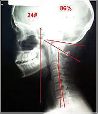 scoliosis-x-ray-head Scoliosis Head Posture
