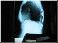 scoliosis-xray-2
