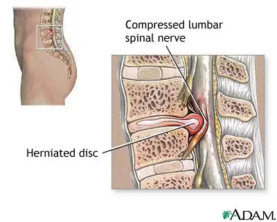 herniated disc side view