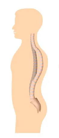 Treat Your Abnormal Spine Curvature Correctly - kyphosis, lordosis